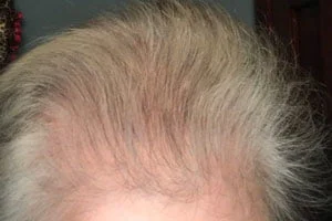 hairmax during 300x200 1 How Often to Use Red Light Therapy for Hair Growth