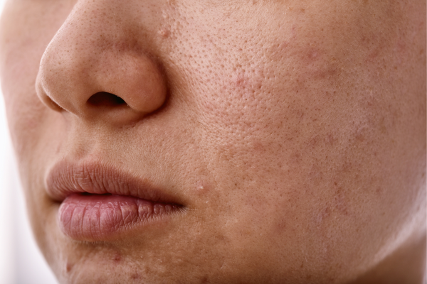 Acne, Eczema, and Skin Injuries Can Trigger Hyperpigmentation