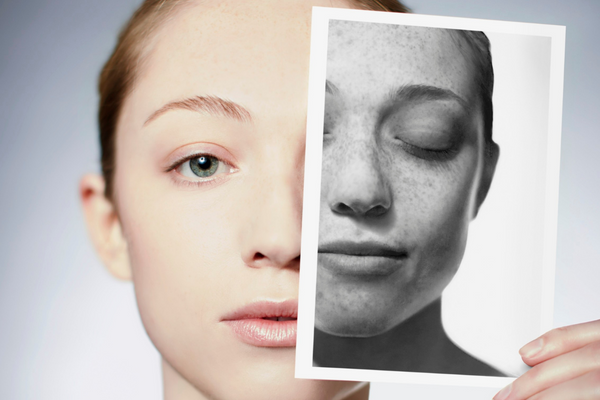 Sun Exposure Causes Hyperpigmentation