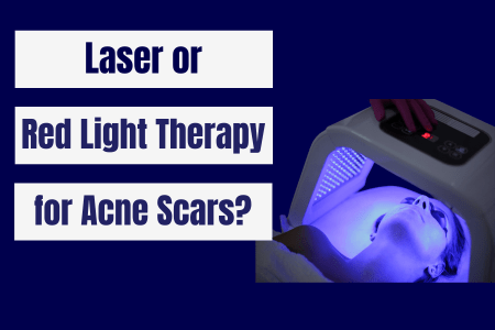 Laser or Red Light Therapy for Acne Scars